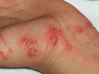 scabies on the hand