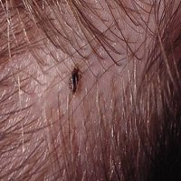 Adult head louse (lice)