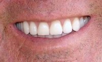 Whitened Dentures