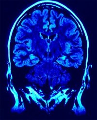 Symptoms of Sleep Related Seizures