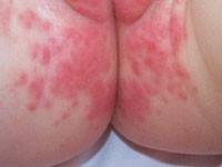 Anal & Perianal Rash