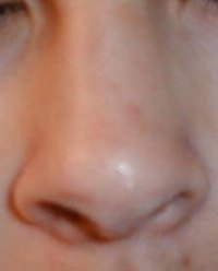 Stop Nosebleeds Fast