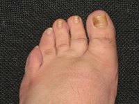 Fungus affects the nail's color and growth.