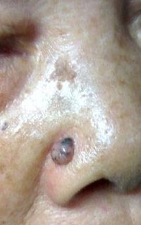 Types of Skin Cancer on the Nose