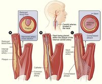 What Are the Treatments for Carotid Artery Blockage?