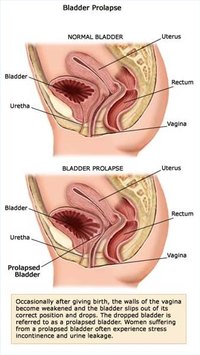 Prolapsed Bladder