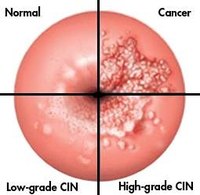 How Does Cervical Cancer Affect the Body?