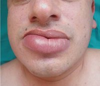 Swollen Lips Treatment