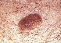 What Are the Treatments for Seborrheic Keratosis?