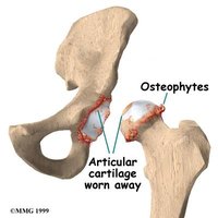 Left untreated, bone spurs can cause an immense amount of pain and even lead to the degradation of muscle in and around the bone.