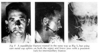 How Long does it Take a Broken Jaw to Heal?
