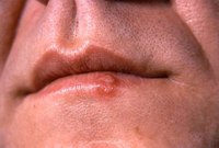 There are a variety of options when treating fever blisters.