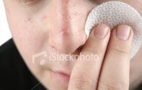 Blackheads
