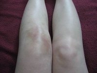 Treatment for Knee Effusion