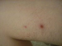 Leg Zits Can Be Cured