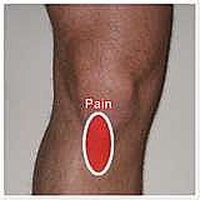 Treat an Inflamed Patellar Tendon