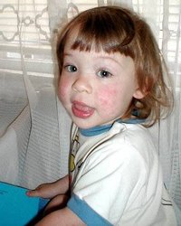 Hives can be caused by a sensitivity to something in the environment.