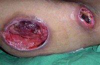 What Are the Stages of Bed Sore Development?