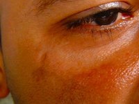 Treating Old Scar Itch