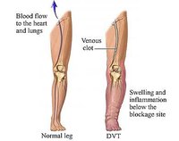 How To Tell If You Have A Blood Clot
