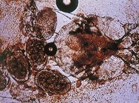 Scabies Mite: A Microscopic Menace