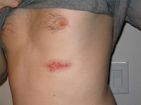 Diet for Herpes Zoster
