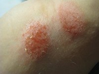 Red, Itchy Follicular Eczema