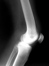 Name the Different Types of Arthritis