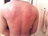 Causes of Hives
