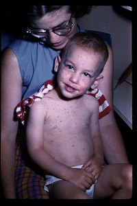 Signs & Symptoms of the Chicken Pox
