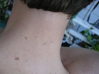 What Typical Moles May Look Like