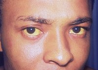 Jaundiced eyes can be a sign of serious liver disease.