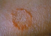 Developmental Stages of Ringworm