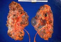 Polycystic kidneys.