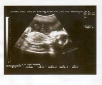 Sonogram showing fetus with head on the right.