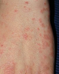 Early Scabies