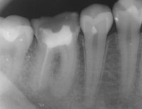 Can a Tooth Abscess Cause Infection in the Body?