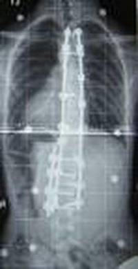 Complications of Spinal Fusion With Harrington Rods