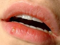 Should I Pop a Fever Blister?