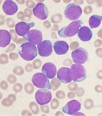 Types of Leukemia in Adults