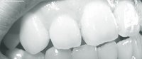 Problems With Teeth Veneers