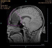 Brain Tumor Warning Signs