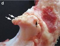 What bone spurs look like.