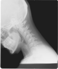 What Is C4-C5 Spondylosis?