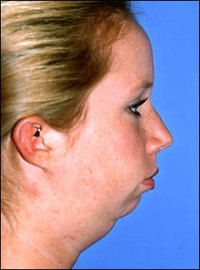 Underbite Surgery Procedures