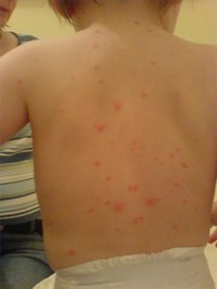 The tell-tale rash of varicella, or chickenpox, can be seen on this child's back.