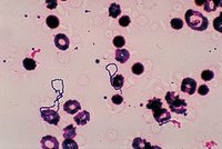 What is a Mercer Infection?