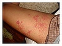 Early Signs of Shingles