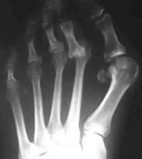 Hammertoes Surgery Complications