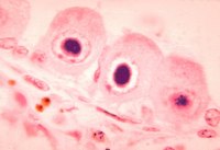 Kidney Failure Caused by a Urinary Tract Infection